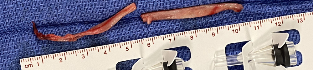 A 10-cm segment of catheter-related sheath removed using mechanical thrombectomy.