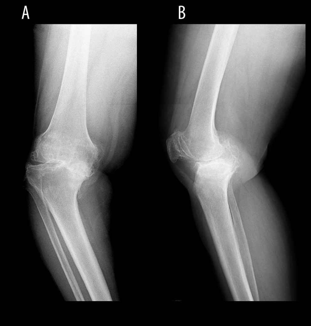Preoperative radiograph of the right knee (Case 1), anteroposterior (A) and lateral (B) views.