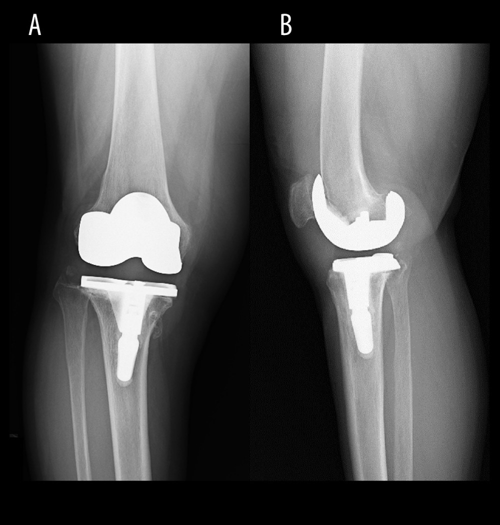 Postoperative radiograph of the right knee (Case 1), anteroposterior (A) and lateral (B) views.
