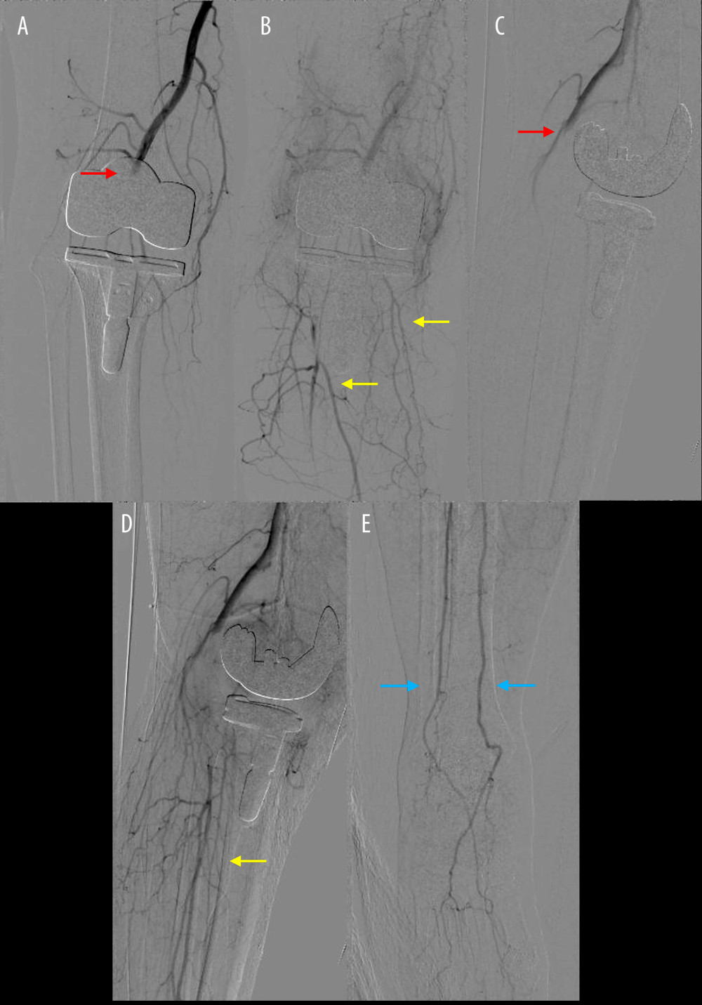 Angiography of the right knee showing occlusion of the popliteal artery with collateral perfusion of the anterior tibial artery, peroneal artery, and dorsalis pedis artery (Case 1); anteroposterior (A) and lateral (C) views of early phase showing occlusion of the popliteal artery (red arrow); anteroposterior (B) and lateral (D) views of late phase showing collateral perfusion of the anterior tibial artery and the peroneal artery (yellow arrow); and angiography of the right foot (E) showing the blood flow of the dorsalis pedis artery (blue arrow).