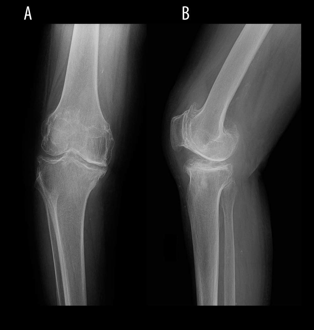 Preoperative radiograph of the right knee (Case 2), anteroposterior (A) and lateral (B) views.