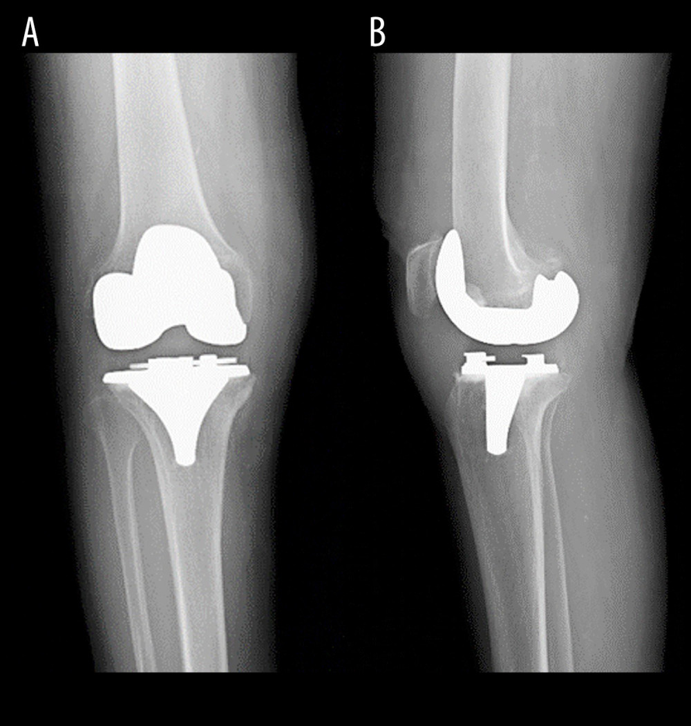 Postoperative radiograph of the right knee (Case 2), anteroposterior (A) and lateral (B) views.