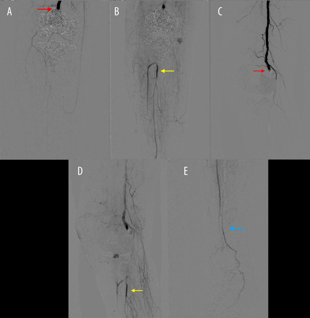Angiography of the right knee showing occlusion of the popliteal artery with collateral perfusion of the anterior tibial artery; the peroneal artery and medial plantar artery (Case 2); anteroposterior (A) and lateral (C) views of early phase showing occlusion of the popliteal artery (red arrow); anteroposterior (B) and lateral (D) views of late phase showing collateral perfusion of the anterior tibial artery and peroneal artery (yellow arrow); and angiography of the right foot (E) showing the blood flow of the medial plantar artery (blue arrow).