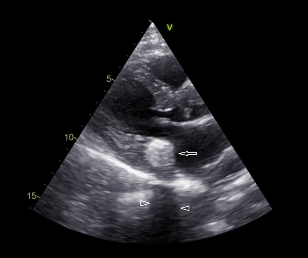 Transthoracic echocardiogram, the parasternal long-axis view showing caseous calcification of the mitral annulus (CCMA). CCMA (arrow) reveals as an echogenic round mass with smooth border in the posterior region of the mitral annulus with mild acoustic shadow (arrowheads) behind CCMA.