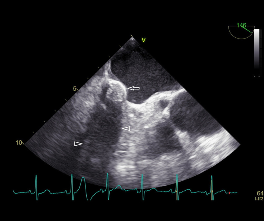 Transesophageal echocardiogram, the midesophageal long-axis view showing caseous calcification of the mitral annulus (CCMA). CCMA (arrow) appears as an echogenic round mass with well-defined border, located in the region of the mitral annulus with mild acoustic shadow (arrowheads) behind CCMA.