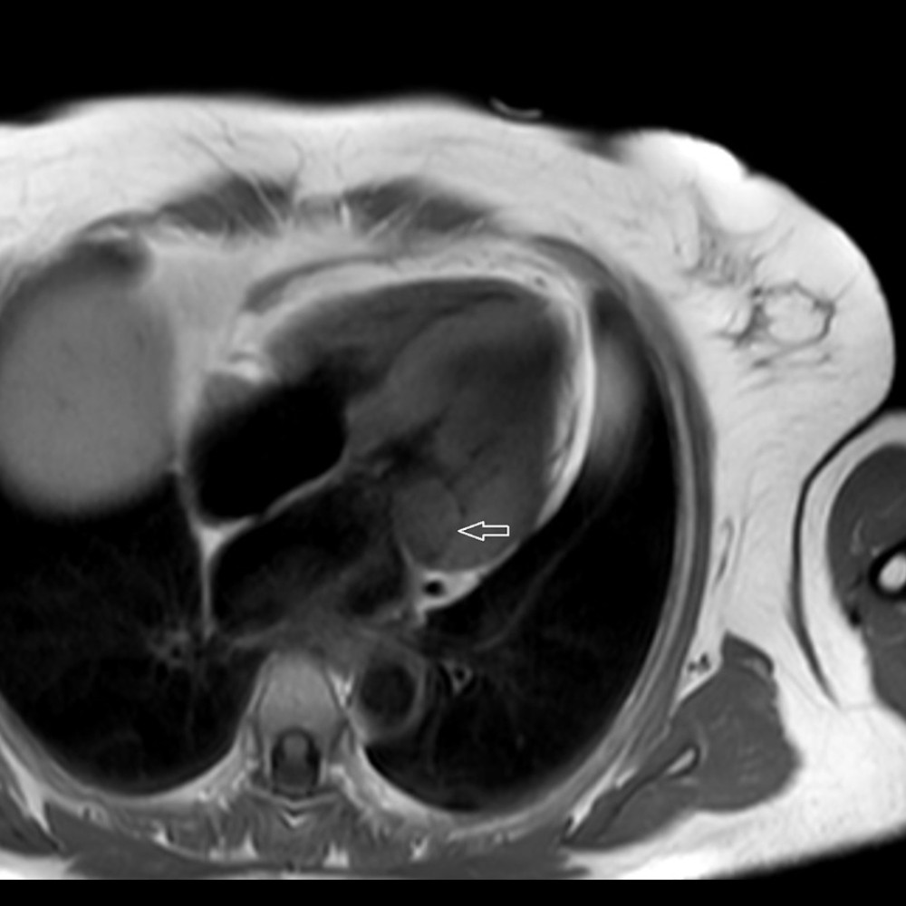 Cardiac magnetic resonance imaging in T1-weighted sequence showing caseous calcification of the mitral annulus (CCMA). CCMA (arrow) is localized in the posterior area of the mitral annulus and the basal segment of the left ventricle, and it is homogeneous and hypointense (dark area).