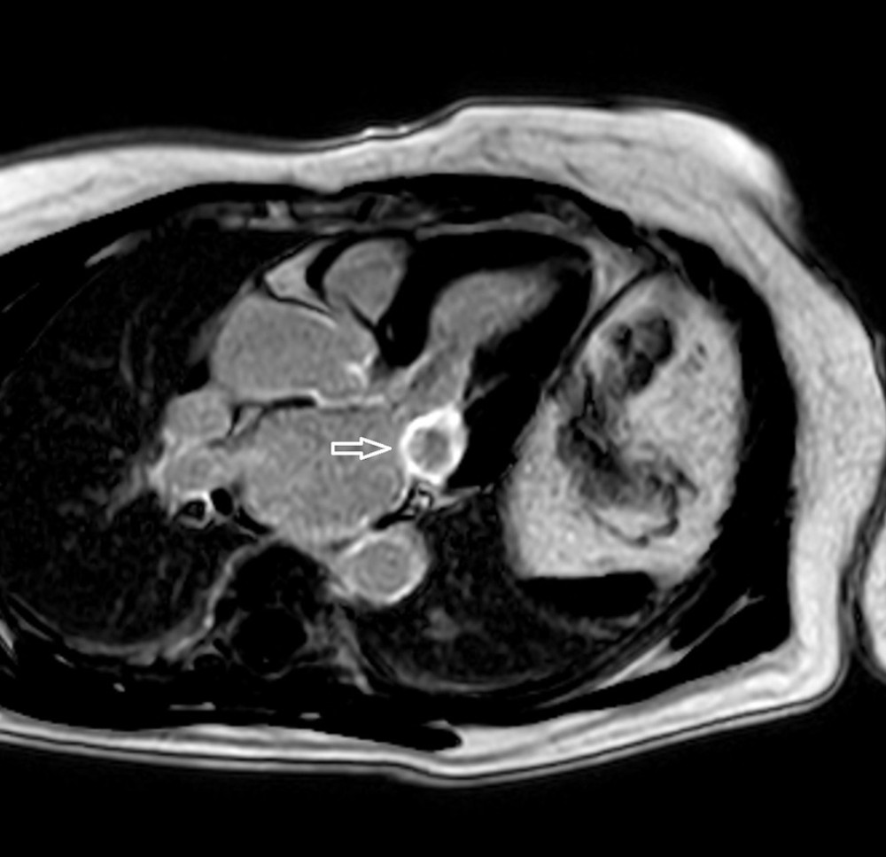 Late gadolinium enhancement cardiac magnetic resonance imaging demonstrating caseous calcification of the mitral annulus (CCMA). CCMA (arrow) is localized in the posterior area of the mitral annulus and the basal segment of the left ventricle. The CCMA has a hypointense area without late gadolinium enhancement surrounded by a hyperintense envelope with late gadolinium enhancement.