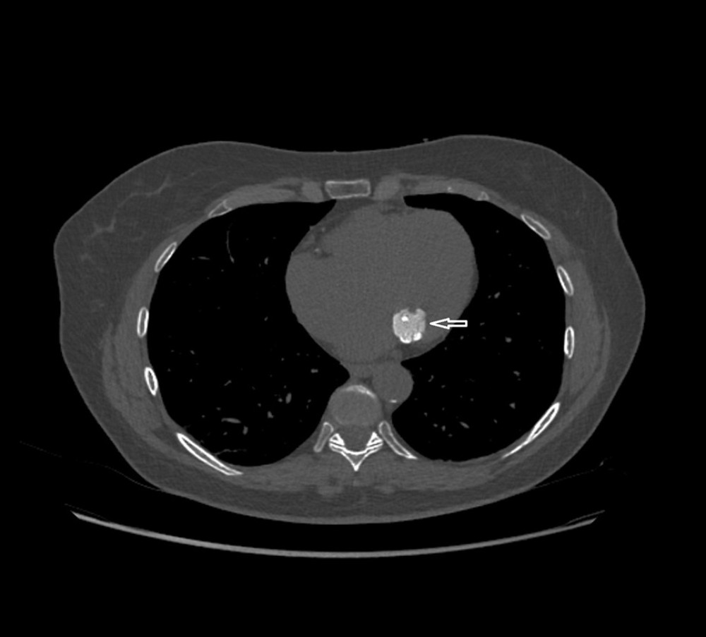 Non-contrast-enhanced computed tomography (CT) with axial reconstruction showing caseous calcification of the mitral annulus (CCMA). CCMA (arrow) is situated in the atrioventricular groove, and it is a hyperdense, well-defined, round mass, measuring 20×19×39 mm and having a couple of internal calcification areas and a partly calcified border. The attenuation value range of the central area of the lesion was from 410 HU to 650 HU. The edge of the mass had the attenuation value range from 723 HU to 1245 HU. The internal calcification areas of the lesion had attenuation values ranging from 1124 HU to 1169 HU.