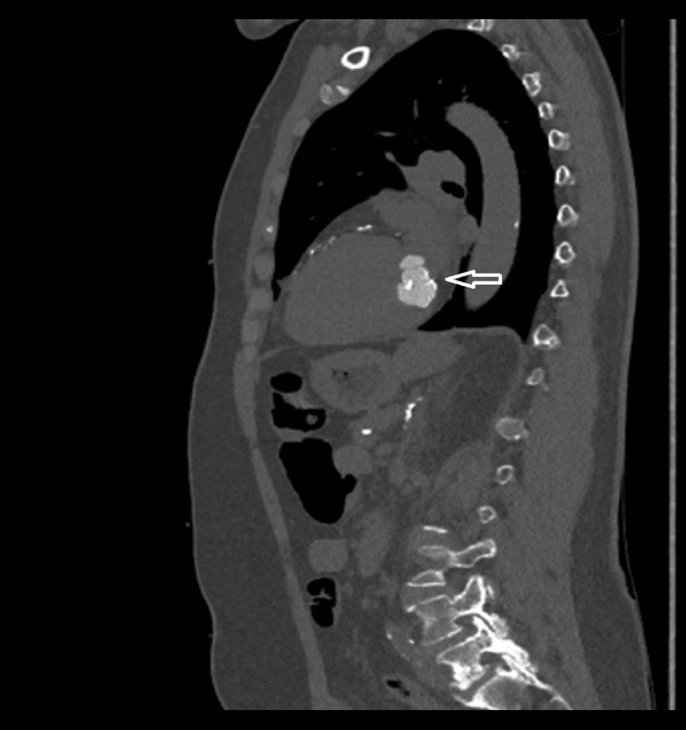 Non-contrast-enhanced computed tomography (CT) with sagittal reconstruction demonstrating caseous calcification of the mitral annulus (CCMA). The CCMA (arrow) is localized in the atrioventricular groove, and it is a hyperdense, well-defined, round mass, with a couple of internal calcification areas and partly calcified border. The attenuation value range of the central area of the lesion was from 410 HU to 650 HU. The edge of the mass had the attenuation values ranging from 723 HU to 1245 HU. The internal calcification areas of the lesion had attenuation values ranging from 1124 HU to 1169 HU.