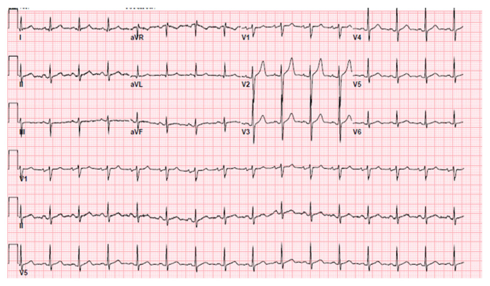 EKG before Clozapine therapy began showing normal sinus rhythm and ventricular rate.