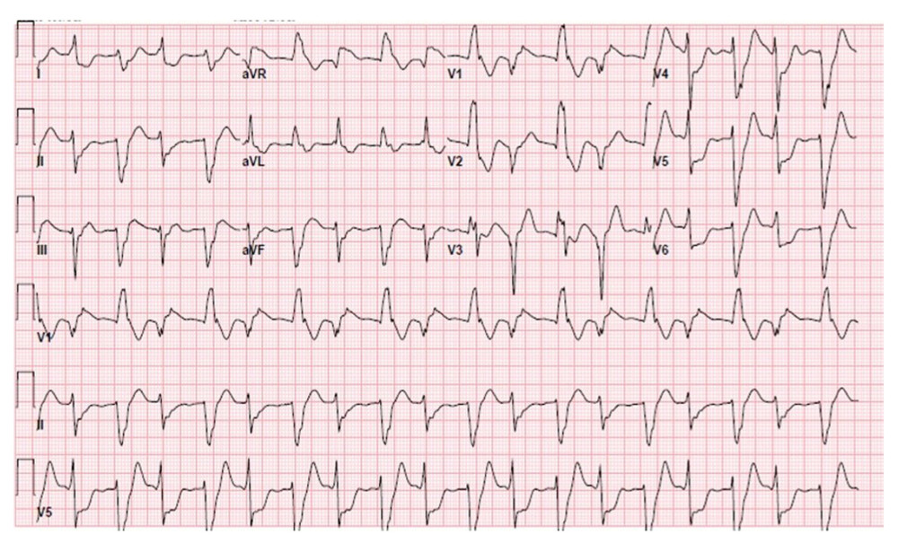 EKG after instituting clozapine therapy showing ventricular bigeminy.