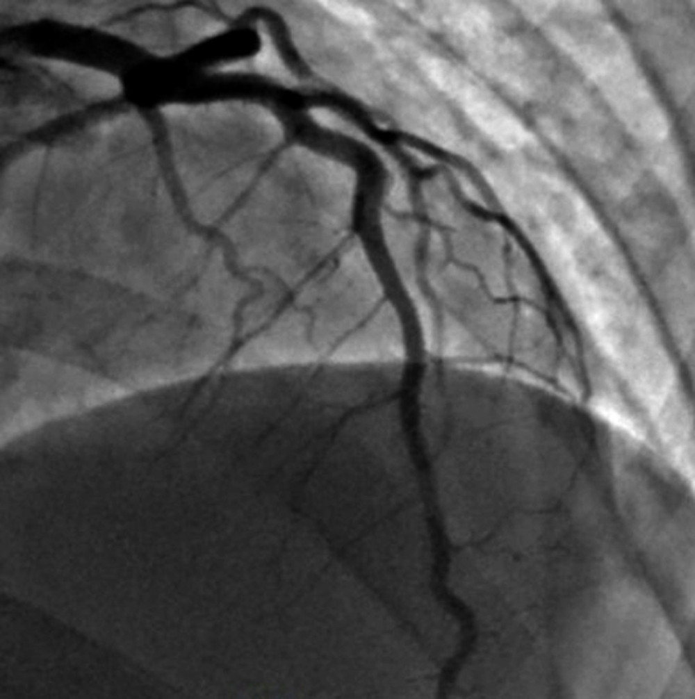 Coronary angiogram, showing normal left coronary artery.