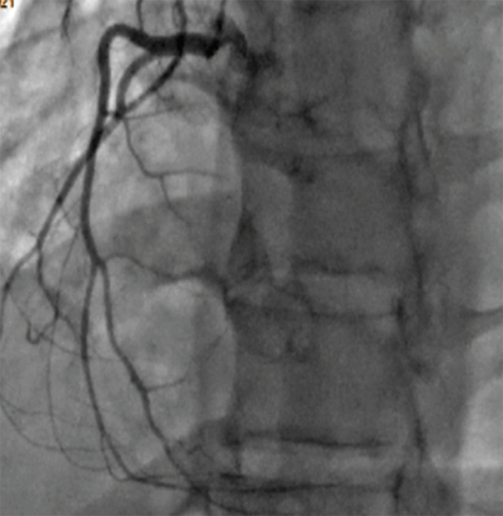 Coronary angiogram, showing normal right coronary artery.