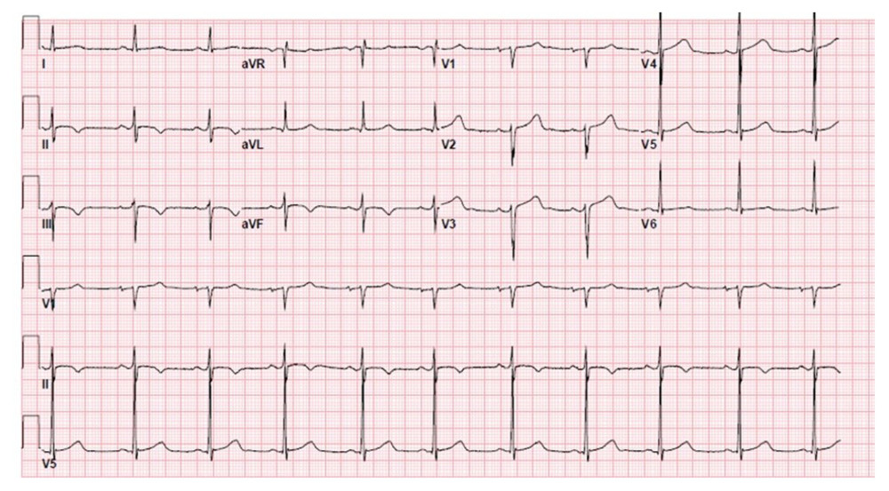 EKG prior to discharge, showing normal sinus rhythm and ventricular rate.