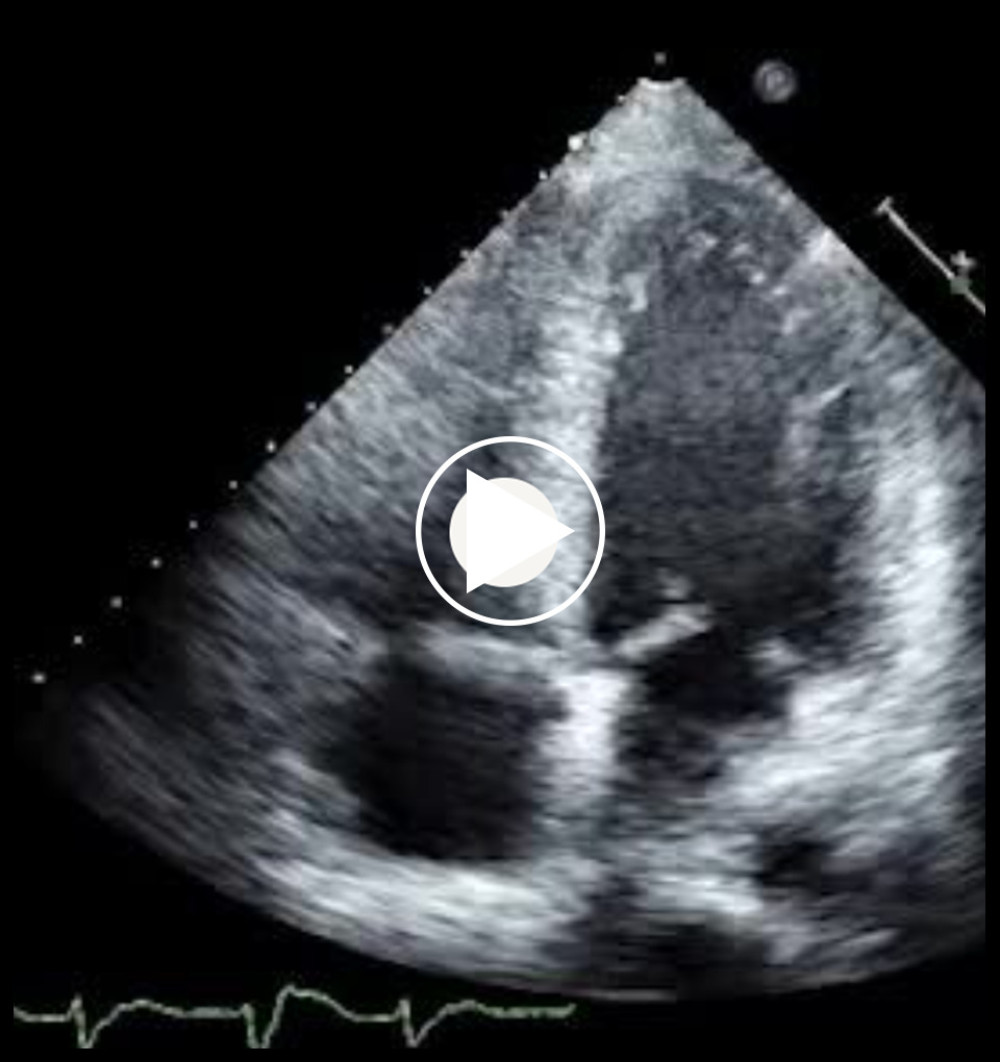 Echocardiogram (apical 4-chamber view), showing reduced ejection fraction during Clozapine therapy.
