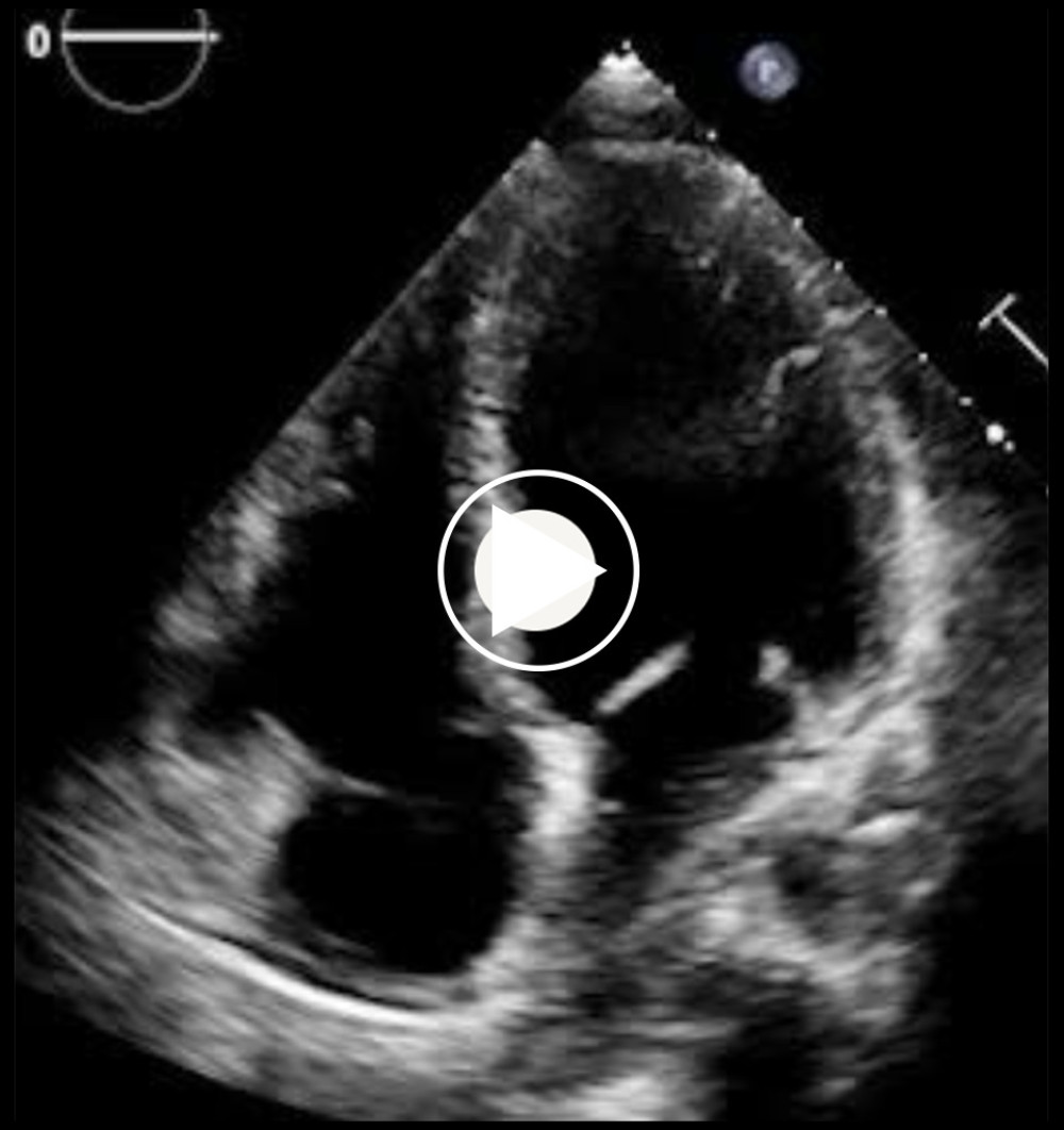 Echocardiogram (apical 4-chamber view), showing improved ejection fraction after discontinuing clozapine therapy.