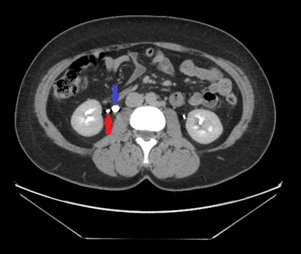 Transversal abdominal computed tomography image acquired 10 min after administration of contrast media showing a right bifid ureter with a branch that has a blind ending (blue arrow) and a single pyelocaliciel system (red arrow).