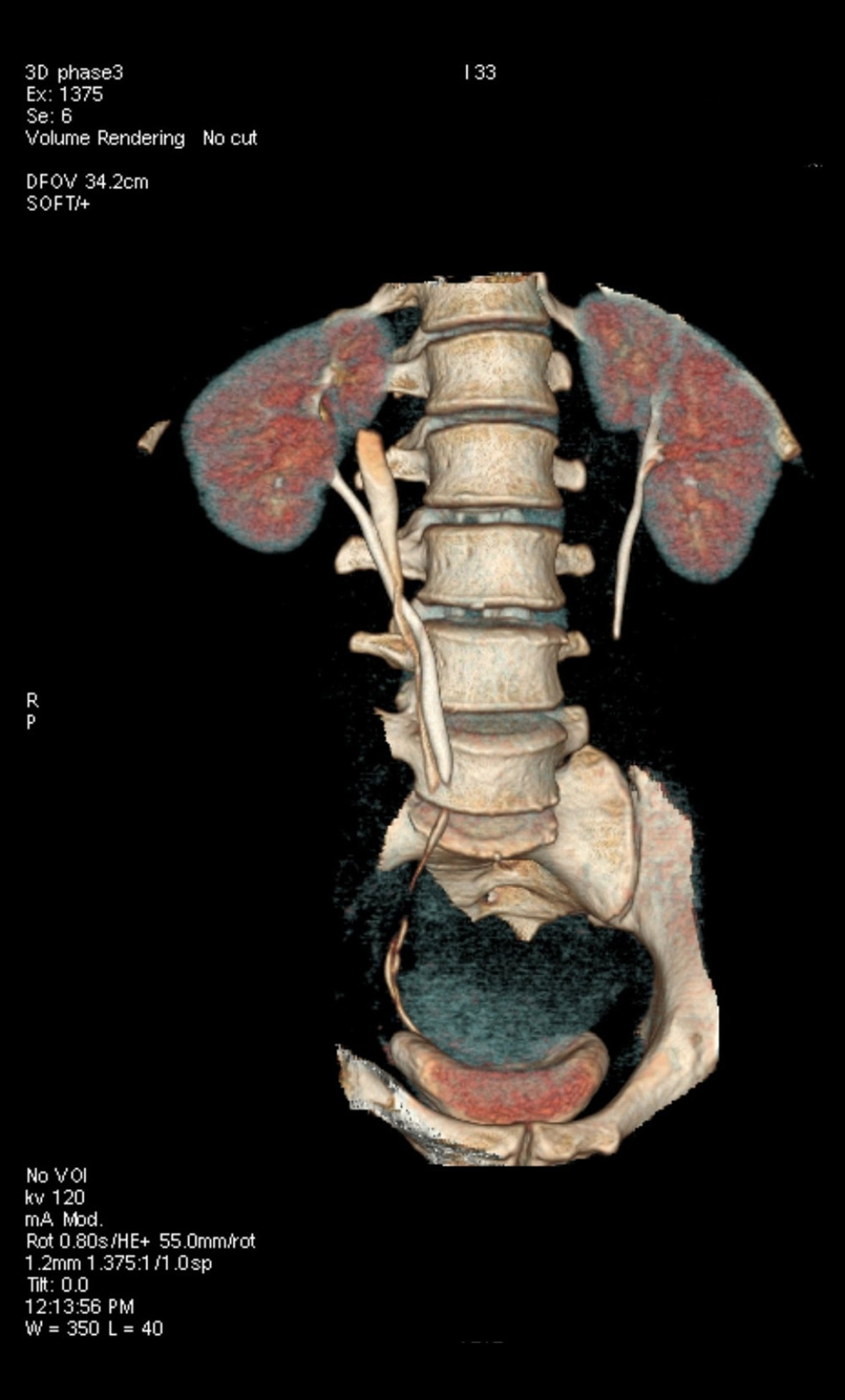 3D reconstruction of the urinary system. The right bifid ureter with blind ending can be clearly seen.