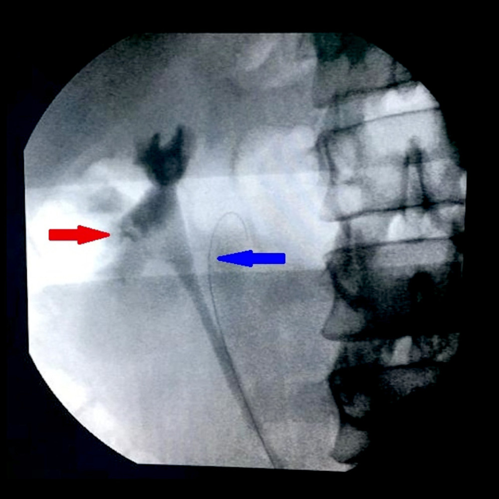 Retrograde uterero pyelograph confirming the single pyelocaliciel system (red arrow). The ureteral catheter is placed in the blind ending (blue arrow).