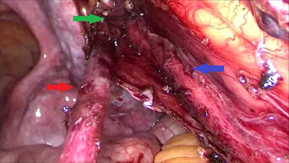Resection of the blind-ending ureter (red arrow) up to the point of its insertion (green arrow) into the healthy ureter (blue arrow).