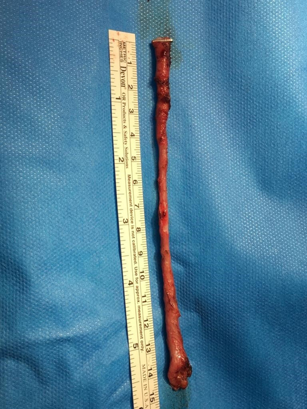 The surgically removed blind-ending bifid ureter.