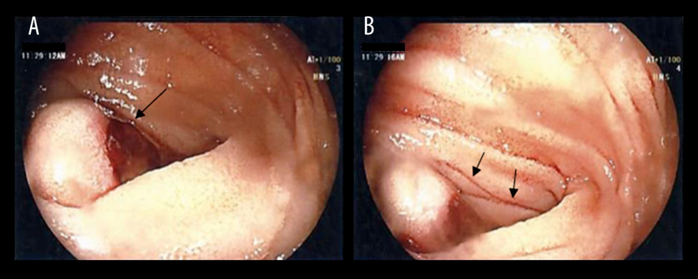 Enteroscopic images of the jejunal Dieulafoy’s lesion in-situ. The lesion is being viewed from a proximal perspective protruding into the jejunal lumen where an adherent clot is noted on its surface (A) and streaks of blood can be seen heading distally (B).