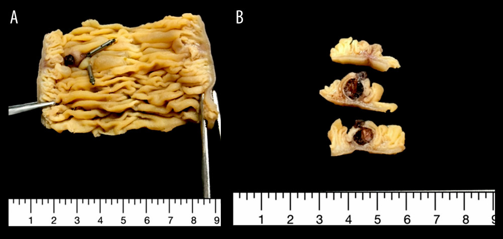 Macroscopic images of the jejunal Dieulafoy’s lesion after resection. Grossly, the jejunal segment featured a small defect in the mucosa through which a protruding blood clot was seen (A). Serial sectioning of this area revealed that the blood clot was centered in the submucosa and measured 1.1×1.0×0.6 cm in size (B).