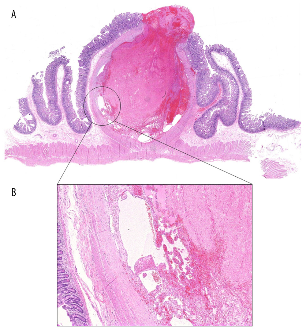 Microscopic images of the jejunal Dieulafoy’s lesion after resection stained with hematoxylin and eosin. Examination showed a large-caliber submucosal artery which feeds into the mucosa through a minute discontinuation (A). Thrombosis of the artery was noted with organization and focal papillary endothelial hyperplasia (B).