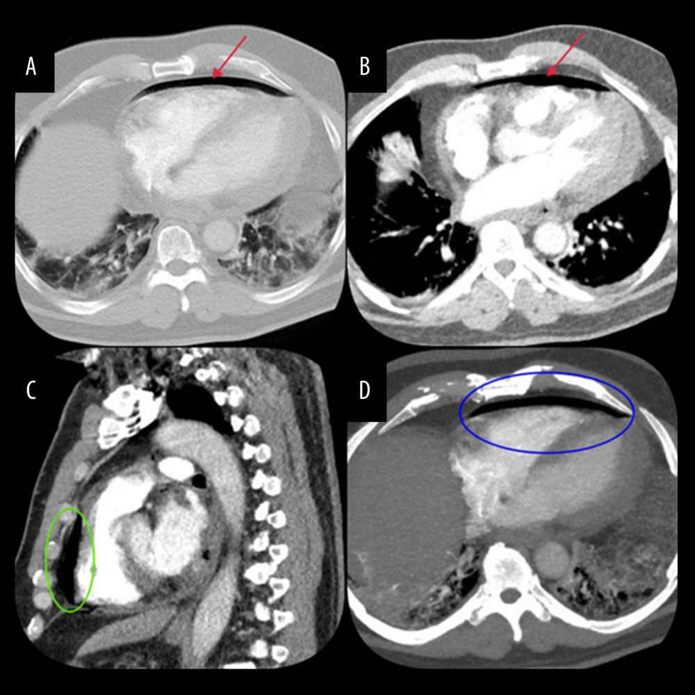 Computed tomography angiogram of the chest showing pneumopericardium (red arrows in A, B) (green & blue circles in C, D).