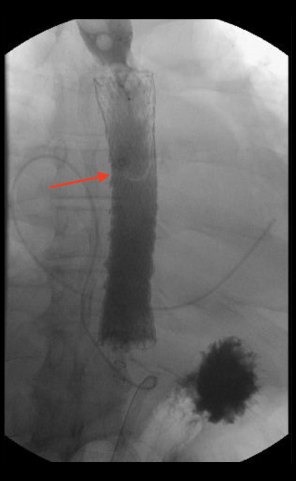 Fluoroscopic image showing a mid-distal esophageal stent (red arrow).