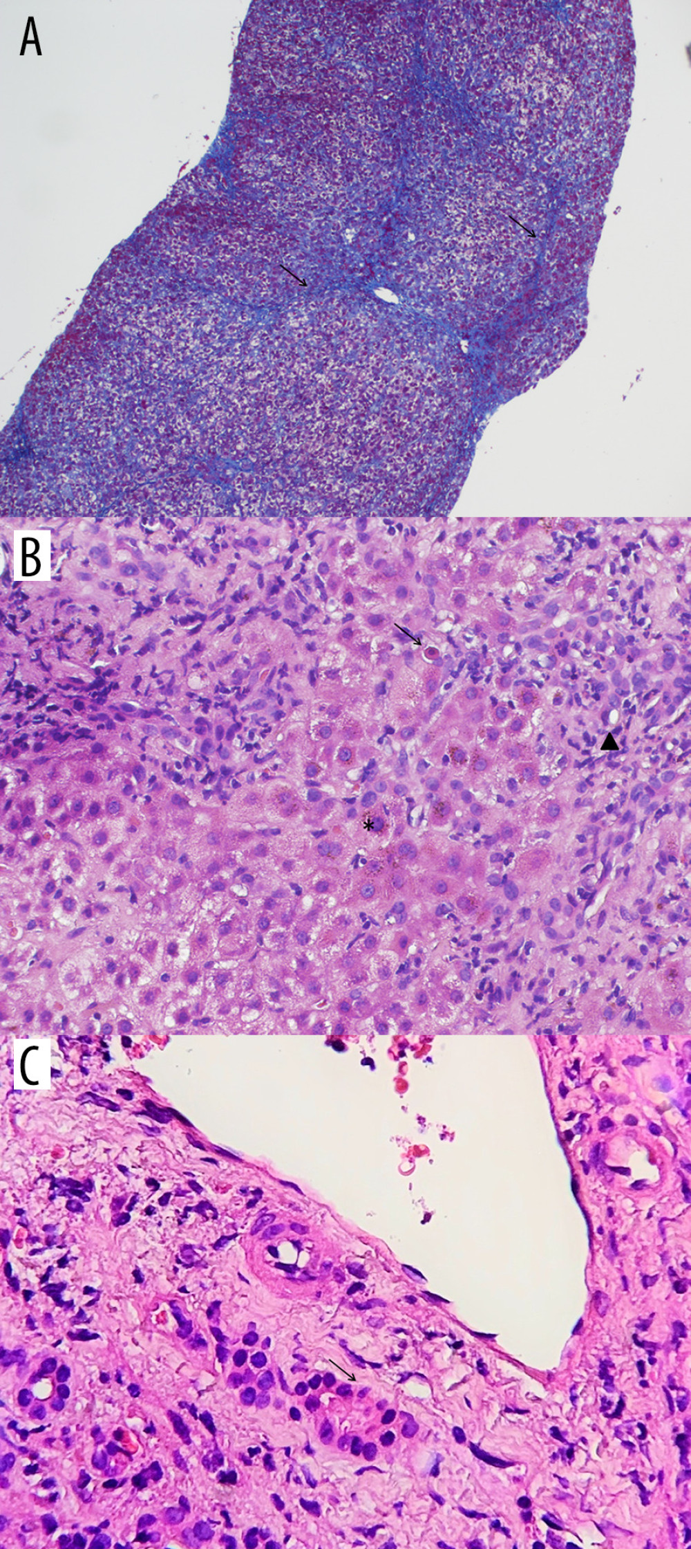 (A) Low magnification of liver parenchyma, exhibiting initial architectural distortion with pericellular fibrosis and delicate septa (arrows), due to recent extracellular matrix deposition (Masson trichrome stain, 4×). (B) Medium magnification of portal area with an acute and chronic infiltrate, ductular reaction (arrow head), and prominent cholestasis (*). Ballooning degeneration and apoptotic hepatocytes (arrow) and spotty inflammation are seen in the adjacent lobule (H&E stain, 10×). (C) Mild epithelial damage of the bile duct (arrow) without ductopenia (H&E stain, 10×).