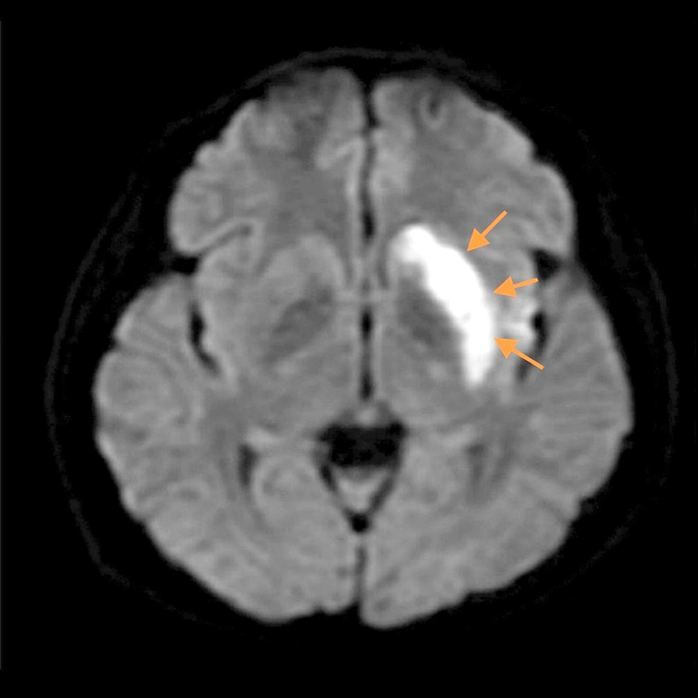 Axial plane of MRI brain with contrast showing acute infarcts over left caudate head nucleus, left lentiform nucleus, and left insular ribbon (orange arrows).