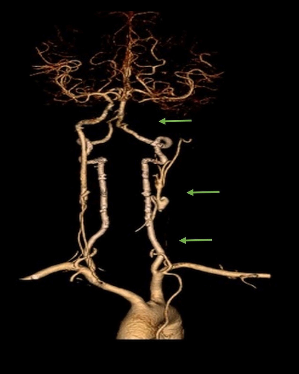 Three-dimensional reconstruction of intracranial and extracranial blood vessels, which showed occluded left ICA (green arrows).