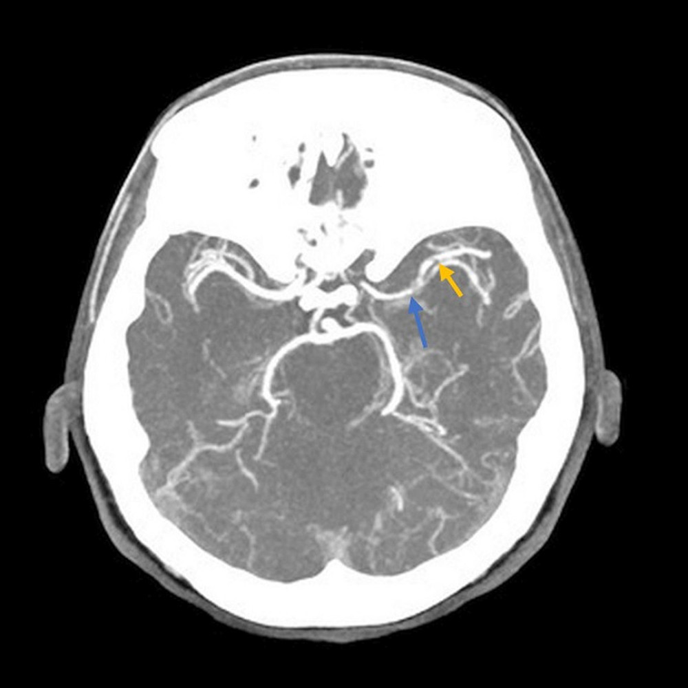 Axial plane CT angiogram showing occlusion of the left MCA-M1 occlusion (blue arrow) and the superior branch of MCA-M2 division. (yellow arrow).
