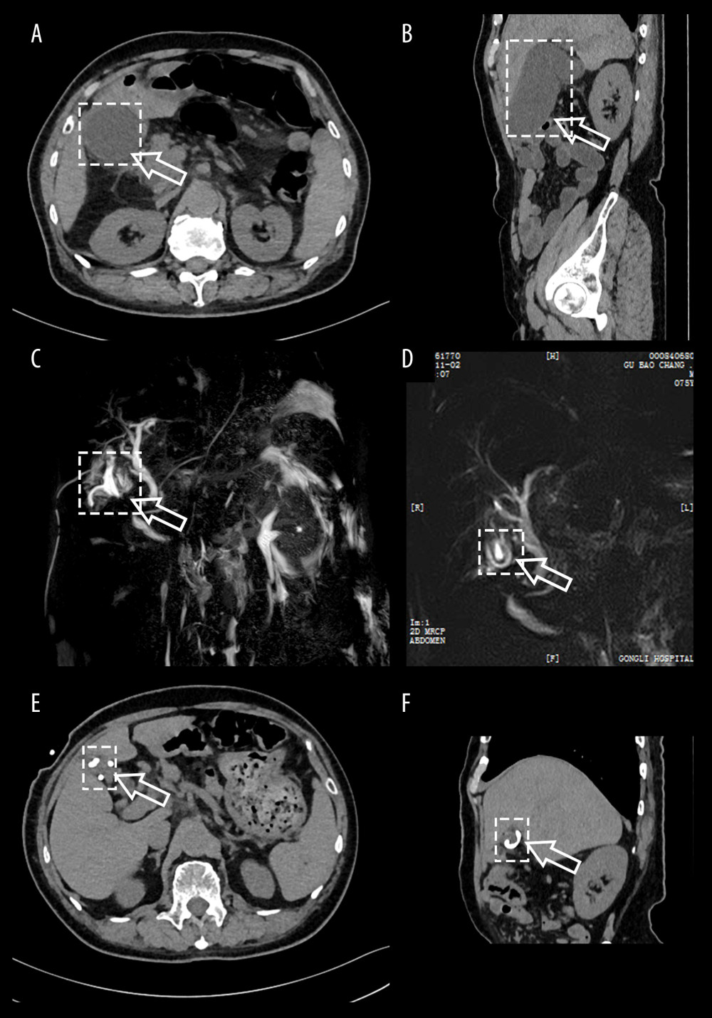 Computed tomography and magnetic resonance images in the treatment course. CT images at the initial diagnosis (A, B), MRI images of the patient who received treatment (C, D), and CT images of the patient at follow-up examination (E, F). White boxes and arrows indicate the size and location of the lesion.