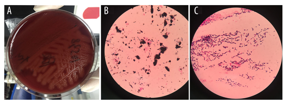 Bacterial colonies of anaerobic cultivation in vitro. Patient-derived blood sample smears (A) and staining (B) at initial diagnosis or after 24 hours of in vitro culture (C).