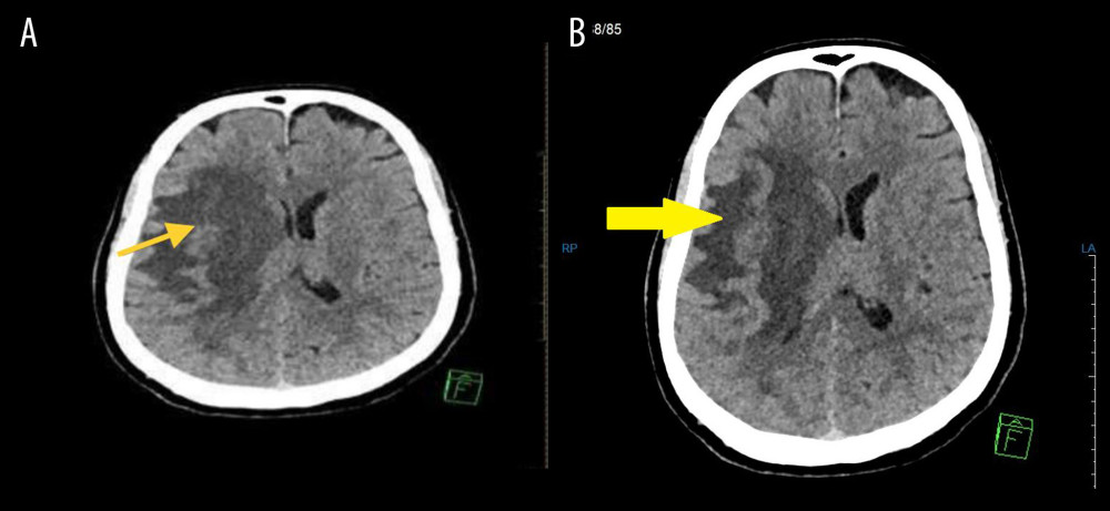 (A, B) Computed tomography of the brain (non-contrast) showed vasogenic edema at the right frontoparietal lobe, right high parietal lobe, and right basal ganglia associated with a 3-mm of midline shift to the left side.