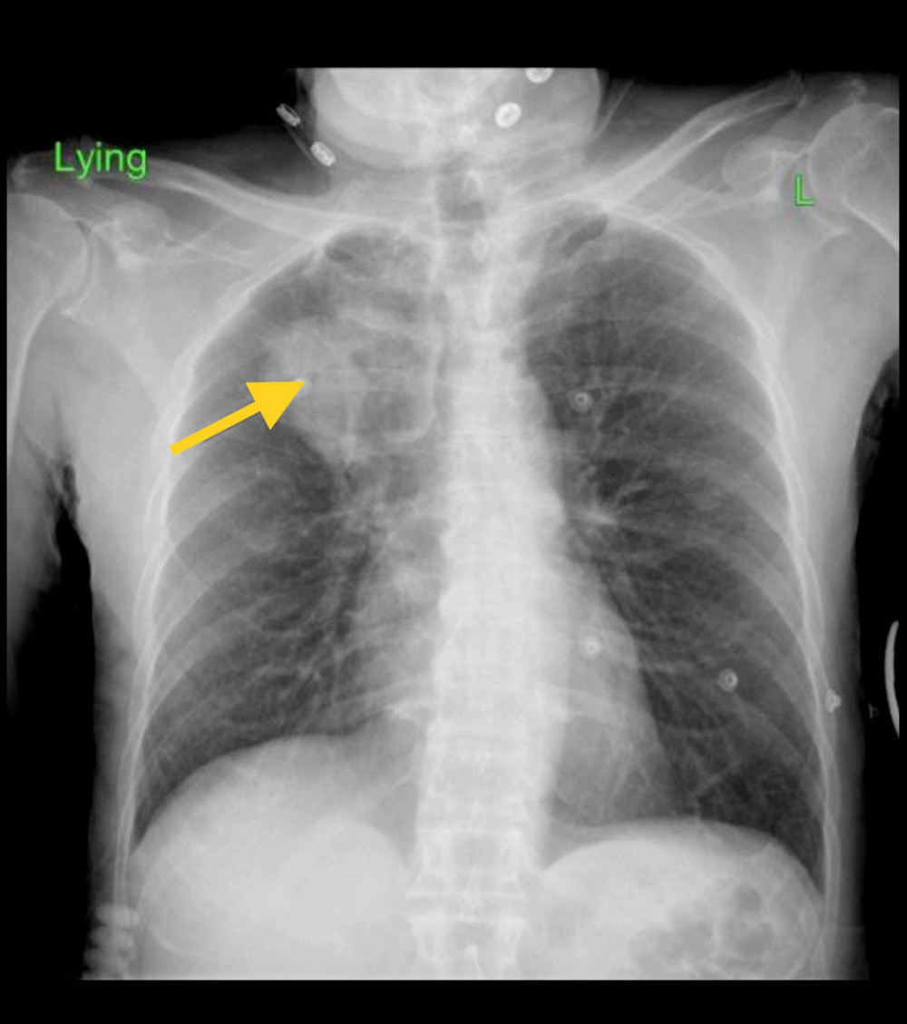 Posterior anterior chest X-ray showing right lung opacity suggesting a mass in the right upper lobe of the lung.