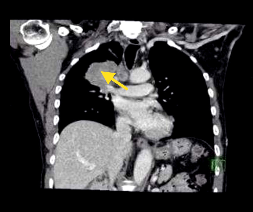 Sagittal computed tomography of the chest showing mass in the anterior segment of the right upper lobe measuring 6.4×4.1×6 cm, associated with enlarged necrotic right paratracheal lymph node as described for histopathological correlation. There were paraseptal emphysema and gravity-dependent atelectatic changes.