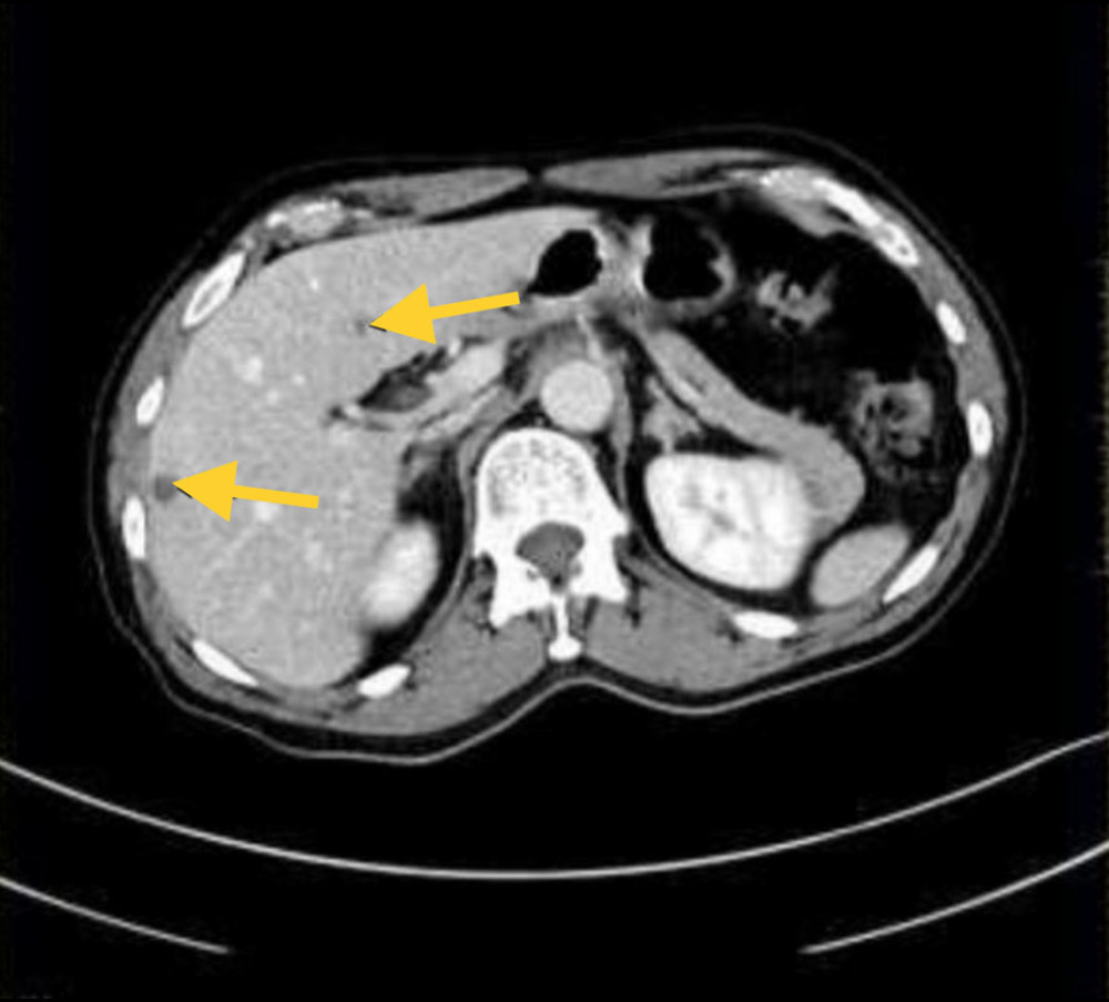 Axial abdomen and pelvic computed tomography revealed normal liver size with multiple hypodense liver lesions.