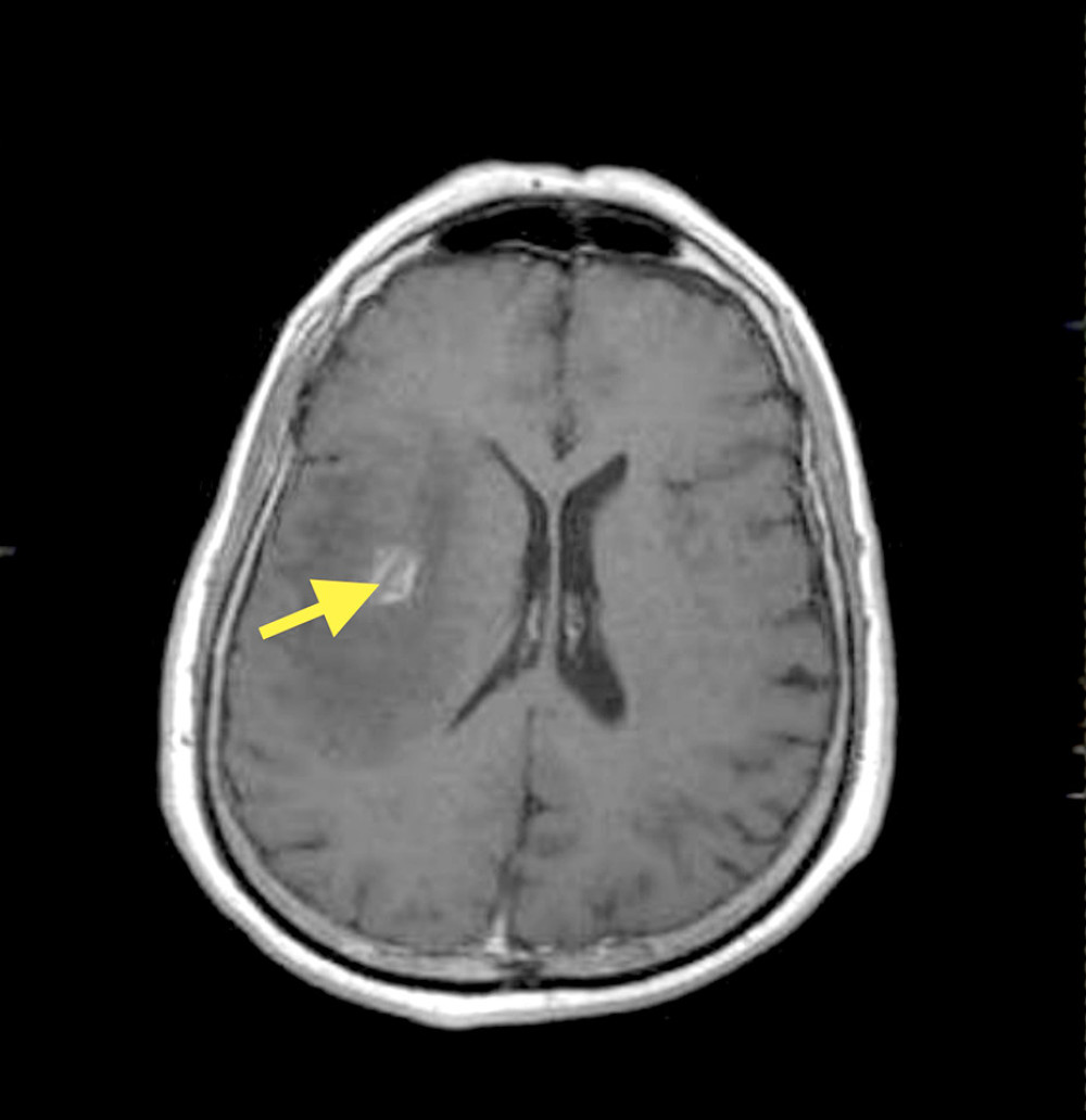 Magnetic resonance imaging of the brain (with contrast) showing 2 ring-enhancing lesions seen within the right temporal and right parietal region with extensive perifocal edema, and midline shift toward the left side by 4 mm.