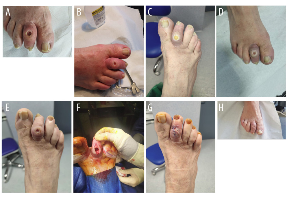Clinical case of a 65-year-old patient with diabetes. (A) Baseline photograph of the patient’s diabetic foot ulcer with signs of infections (day 1). (B) Image of the patient’s ulcer when cured with ammonium polyacrylate polyabsorbent fibers and technology of lipid-colloidal and silver salts in the health center (day 4). (C) Photograph of the patient’s ulcer after being cured in the hospital (day 8). (D) Evolution of the patient’s ulcer (day 12). (E) Image of the ulcer before surgery (day 16). (F) Photograph of the arthroplasty surgery of the toe with tenotomy (day 18). (G) Image of the ulcer after the surgery (day 21). (H) Image of the healed ulcer (day 43).