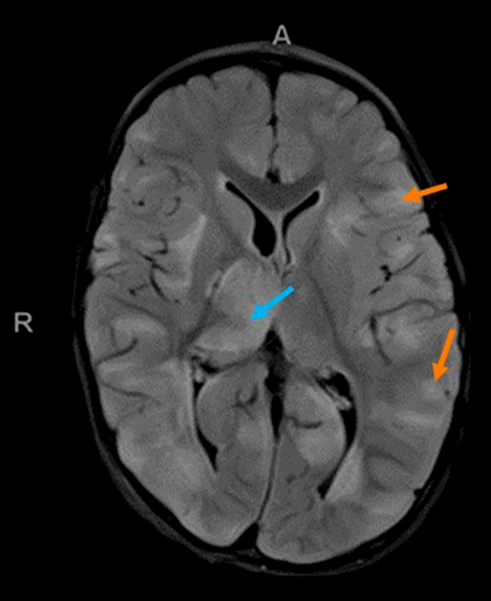 Magnetic resonance imaging-fluid-attenuated inversion recovery (MRI FLAIR) image taken 1 day after hospitalization, demonstrating bilateral and multifocal cortical (orange arrow) and deep gray matter hyperintensities (blue arrow).