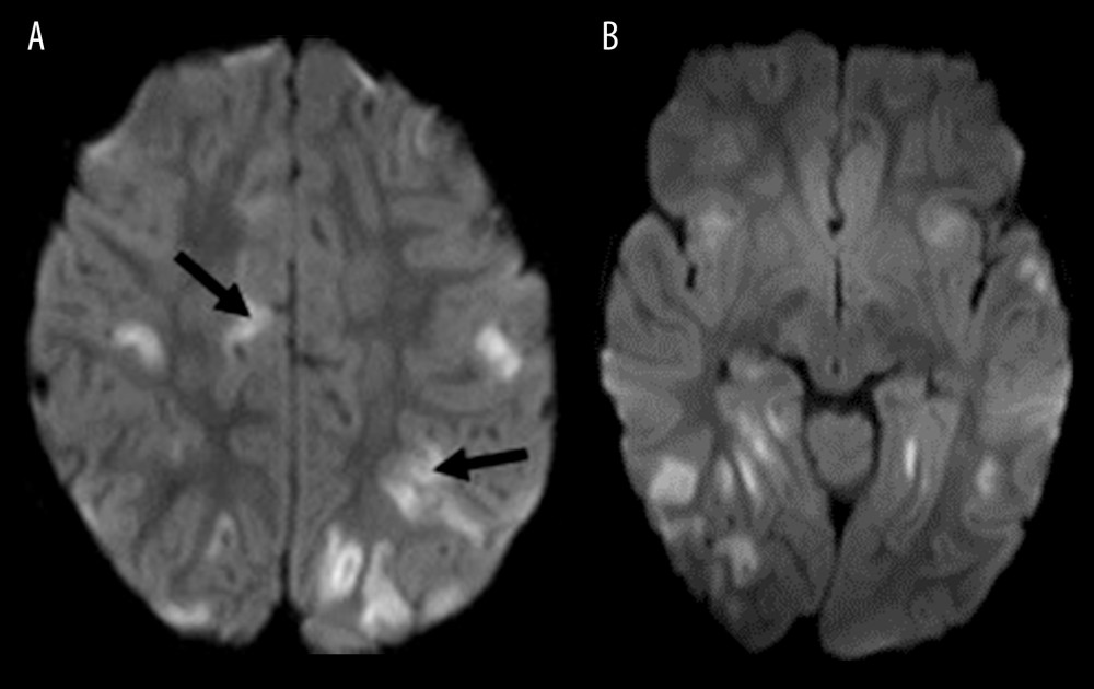 (A) Magnetic resonance imaging (MRI) diffusion-weighted imaging (DWI) 1 day after hospitalization detailing bilateral and multifocal cortical restricted diffusion (black arrow). This is indicative of inflammation. (B) MRI DWI image 1 day after hospitalization from a more caudal position detailing the same findings of restricted diffusion as Figure A.