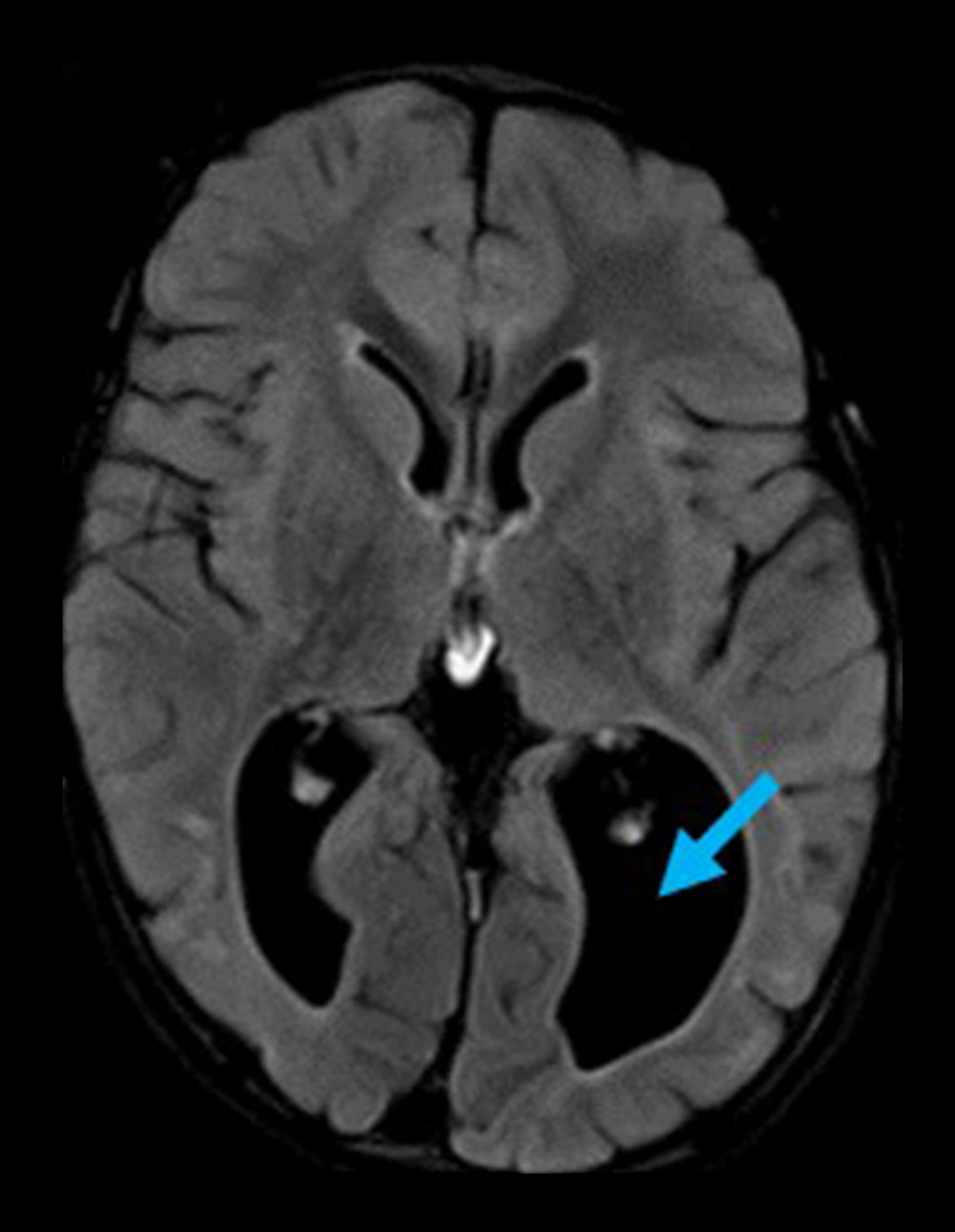 Fluid-attenuated inversion recovery (FLAIR) image 5 months from initial presentation showing improvement in findings of inflammation, given reduced hyperintensities. Also noted in this image is the visible loss of parenchymal volume and dilatation of the posterior elements of the lateral ventricles (blue arrow).