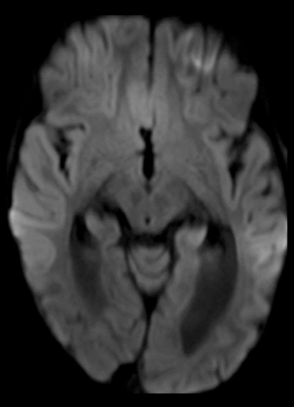 Diffusion-weighted image at 5 months after presentation. Cortical diffusion restriction is absent.