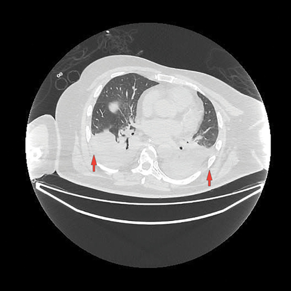 CT of the lung shows bilateral consolidation of the lung parenchymal of the basal zone, bilateral pleural effusions, and compressive atelectasis.