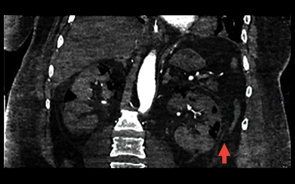 CT of the abdomen reveals bilaterally enlarged kidneys with signs of necrosis, irregular gas particles, and extrarenal enlargement of the process.