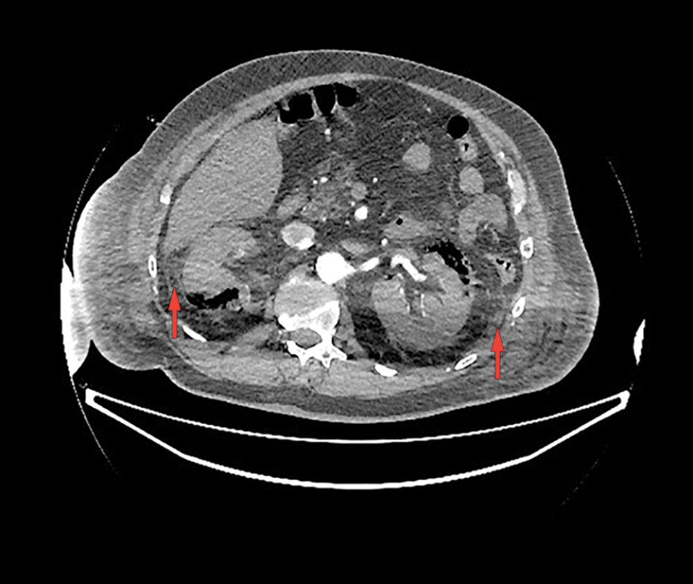 CT exam revealed bilateral emphysematous pyelonephritis type 4 according to the Huang-Tseng classification.