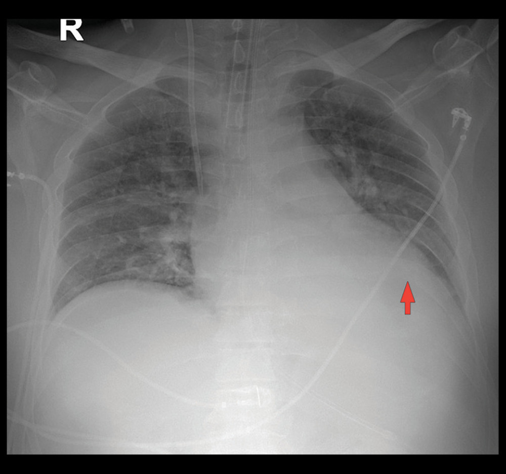 Severe inflammatory changes bilaterally involving a large area of the lung parenchymal.